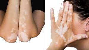  বিশ্ব কুষ্ঠ দিবস ২০২২”কুষ্ঠ আক্রান্ত ব্যক্তিদের সঠিক তথ্য ও শিক্ষা প্রদান করাই হচ্ছে এই দিবসের লক্ষ্য